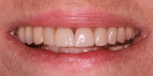 whitening whitening