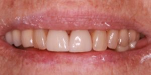 Whitening Whitening