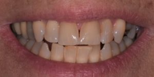 teeth whitening teeth whitening