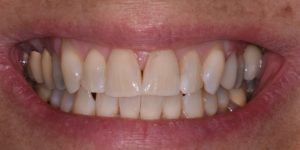 tooth whitening tooth whitening