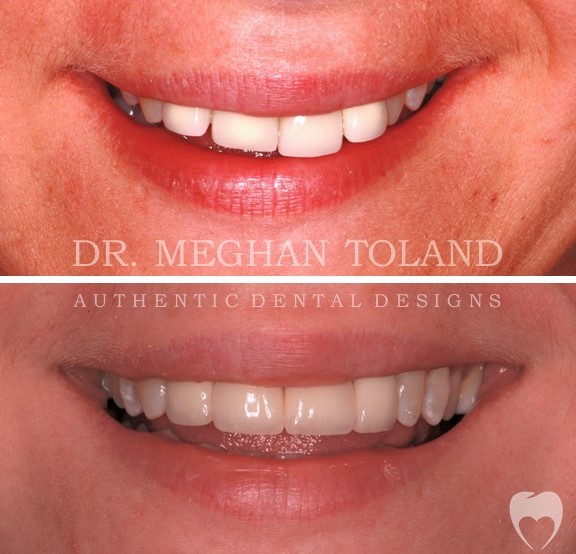 dental crowns